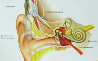 Für wen ist ein Cochlea-Implantat geeignet?